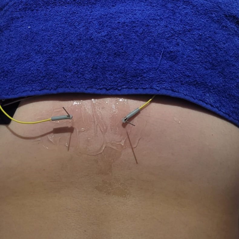 Electro Neuro Acupuntura 1